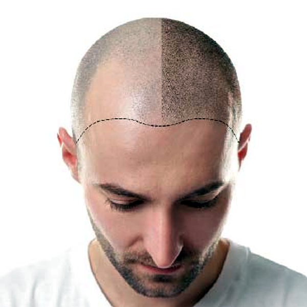 hair-transplant