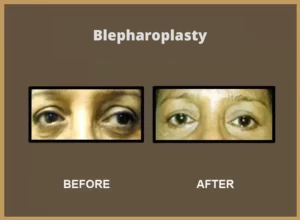 Blepharoplasty-1-300x220-1