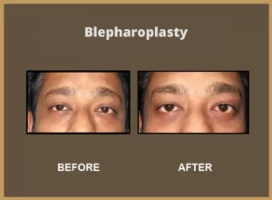 Blepharoplasty-2-300x220-1