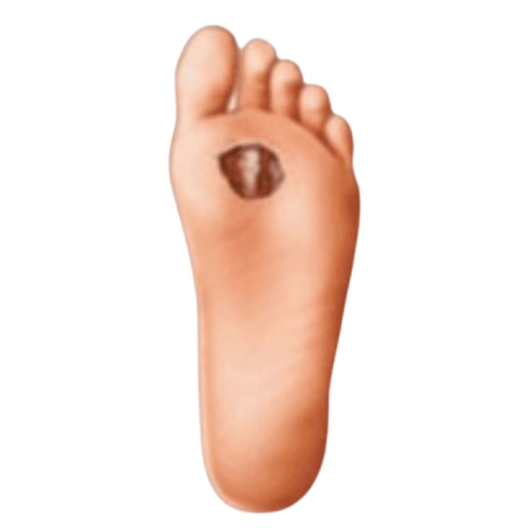 Diabetic Foot & Wounds