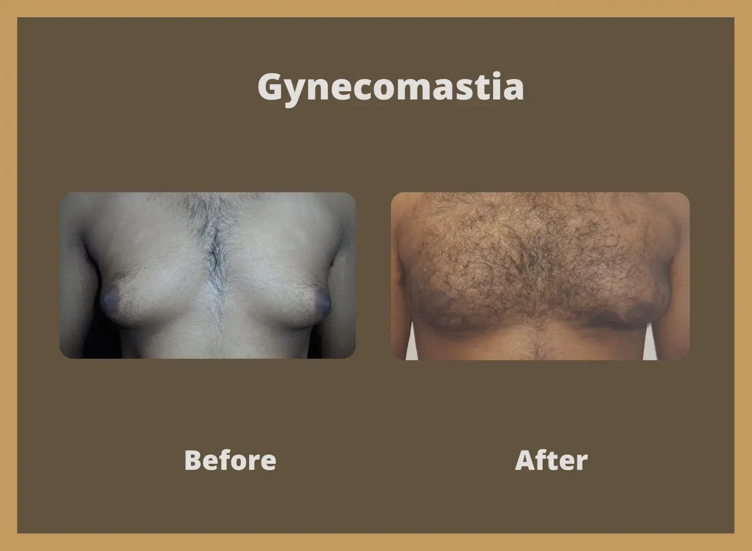 Gynecomastia-1