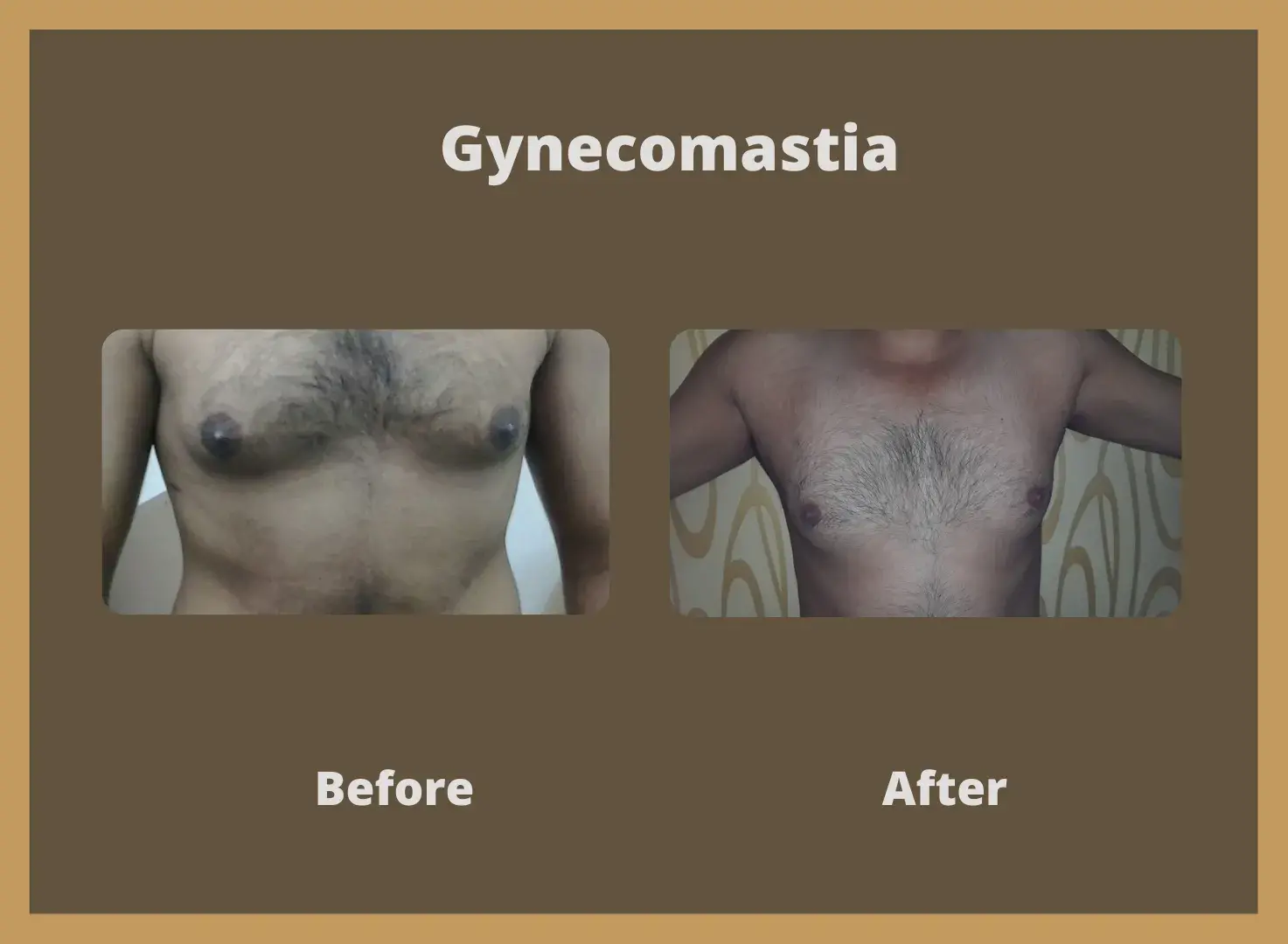 Gynecomastia-2-1