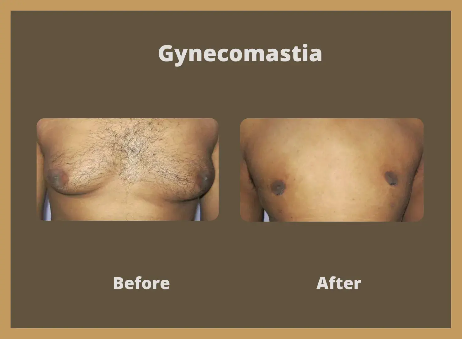 Gynecomastia-3