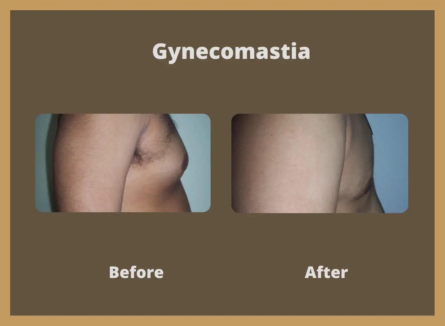 Gynecomastia-4