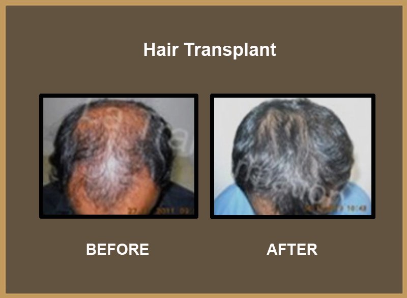 Hair-Transplant-1