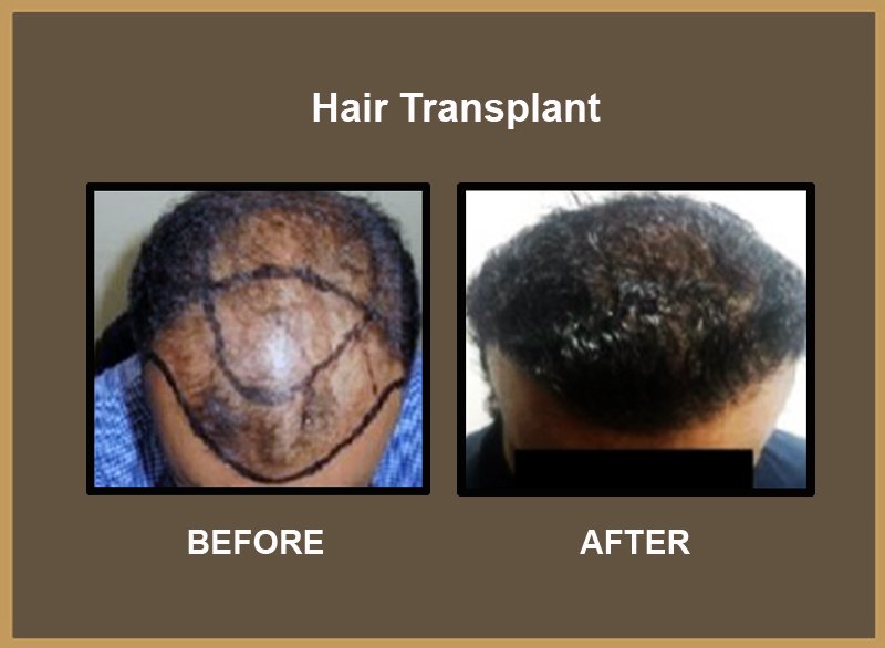 Hair-Transplant-2
