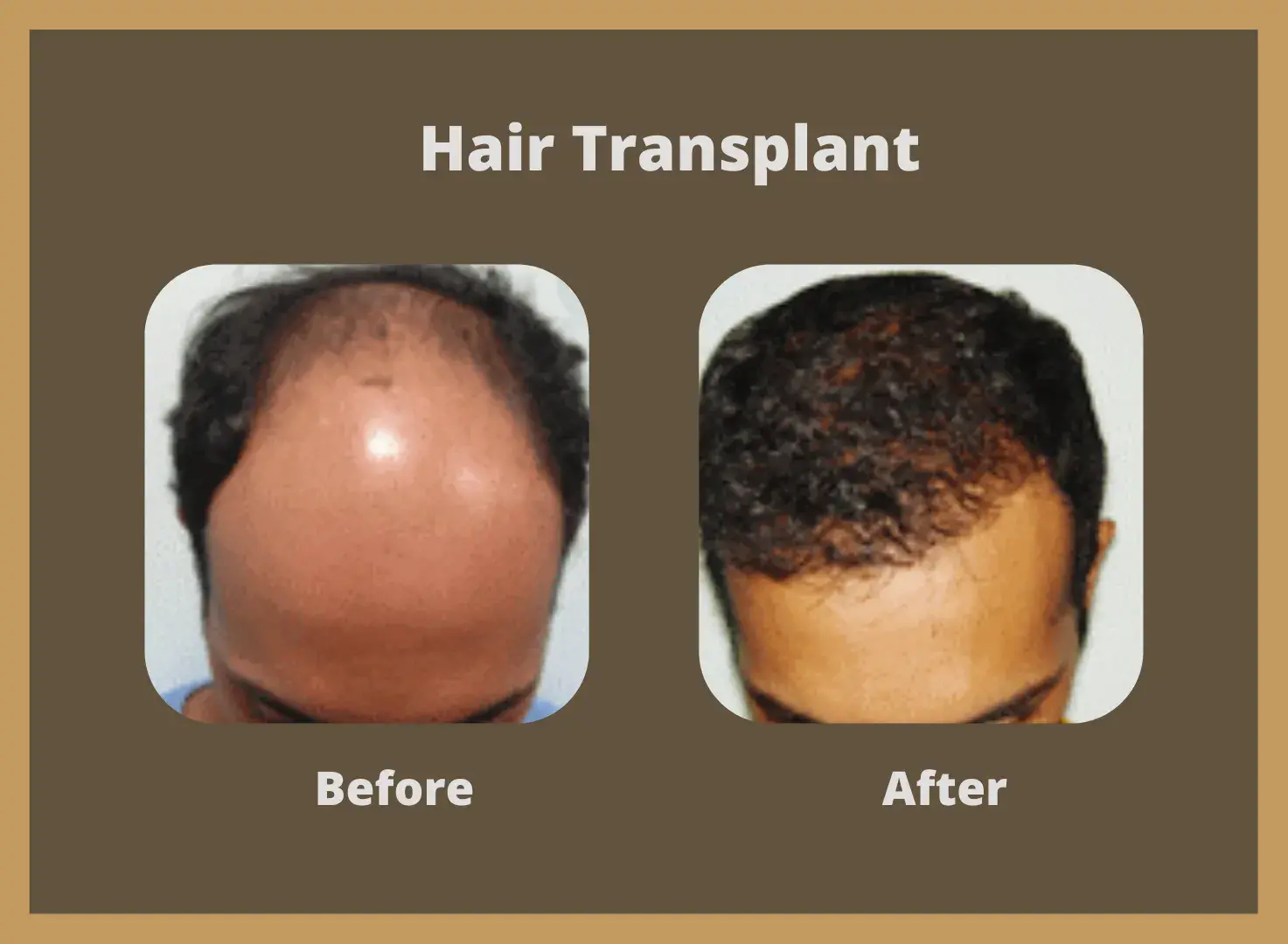 Hair-transplant-10-1