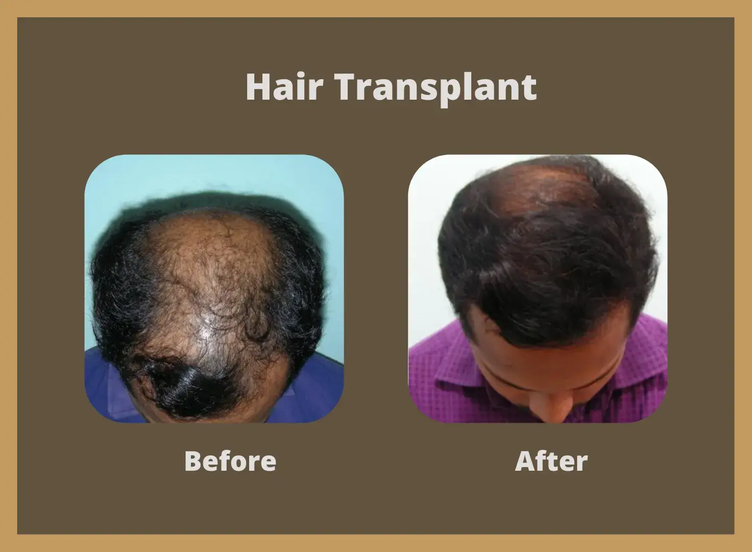 Hair-transplant-11