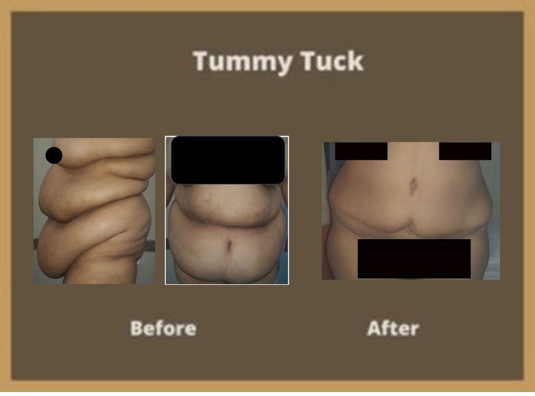 LA-tummy-tuck