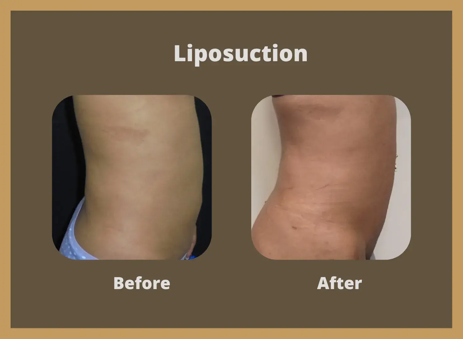 Liposuction-1