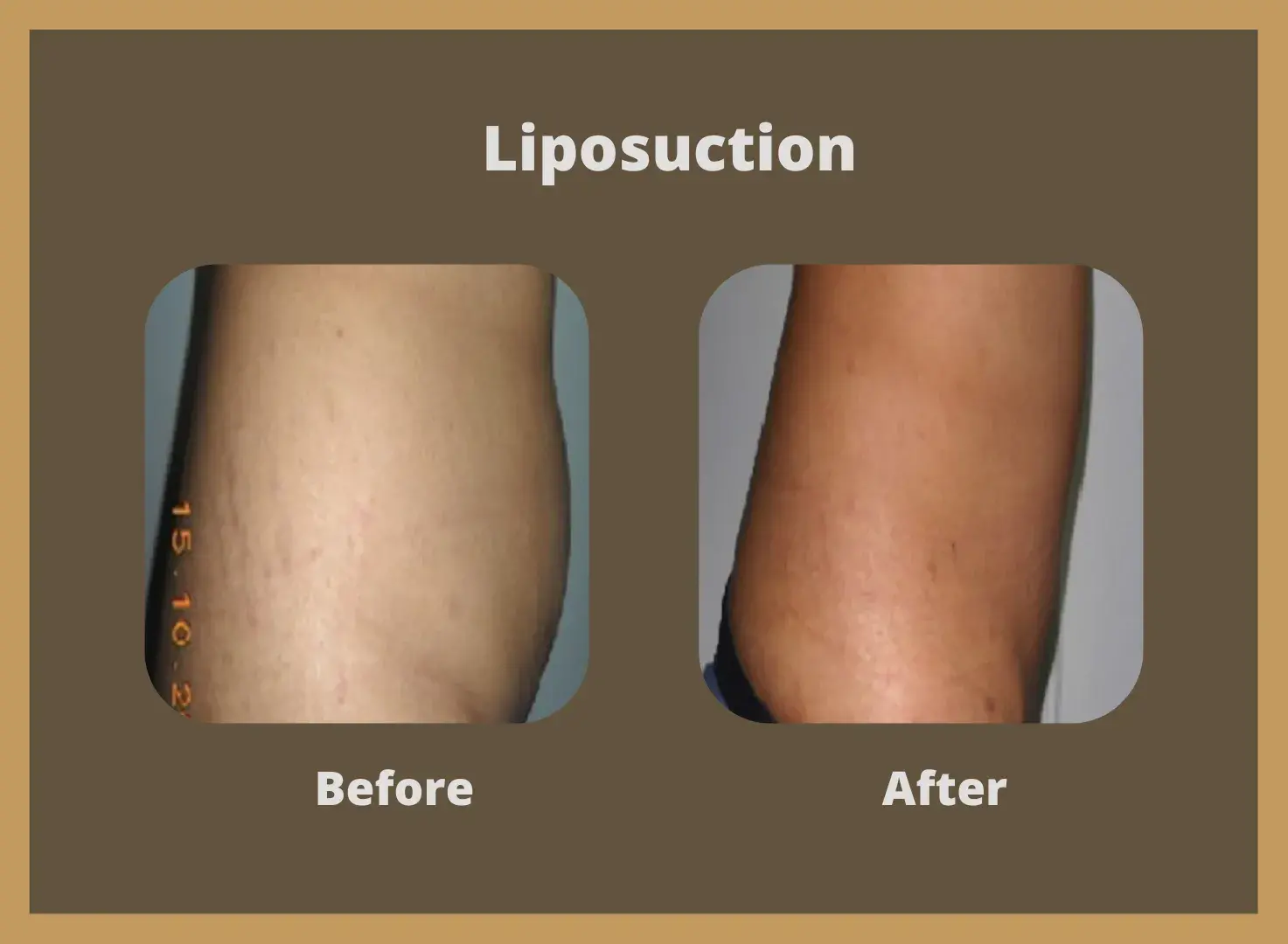 Liposuction-5