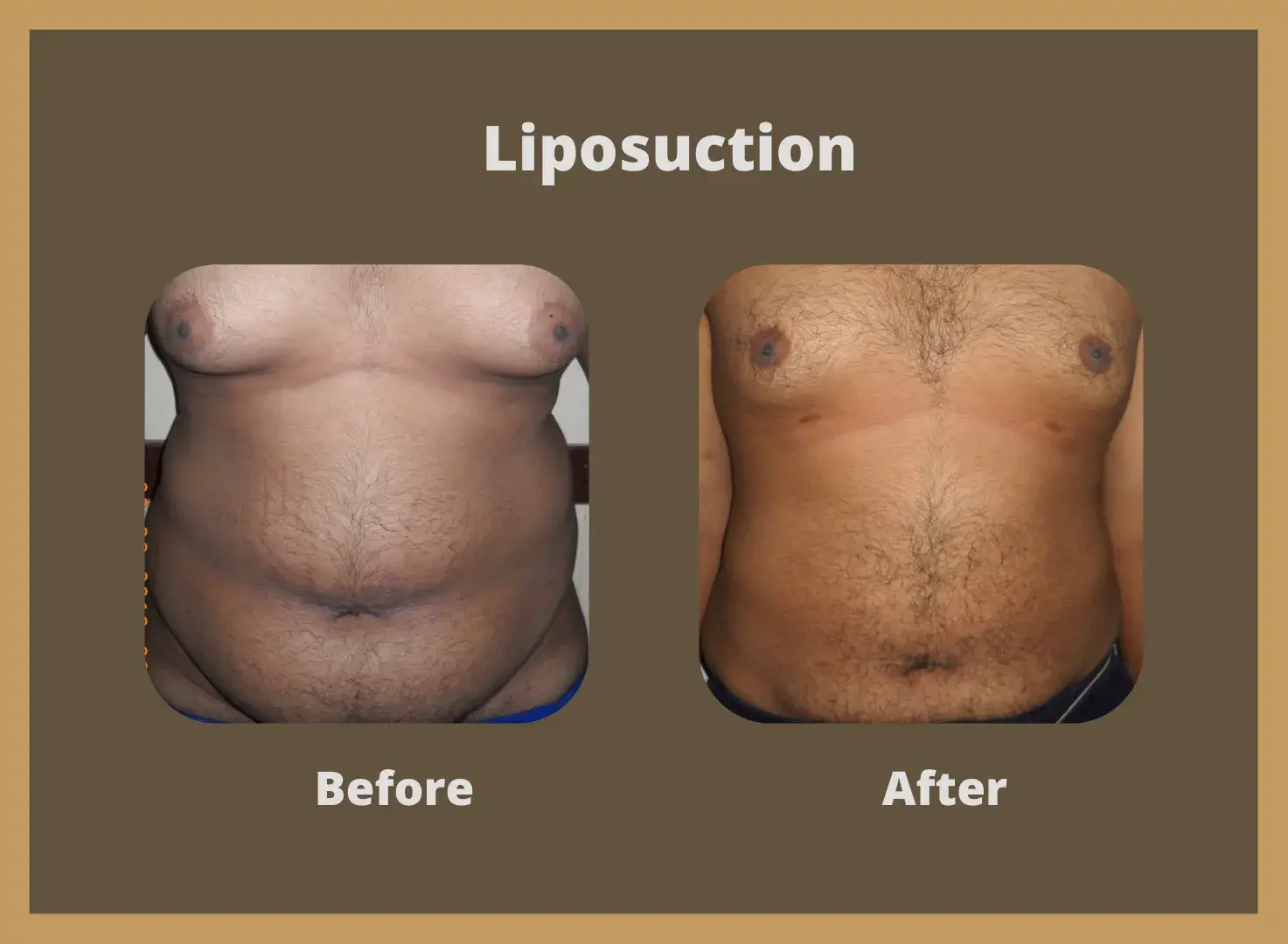 Liposuction-6
