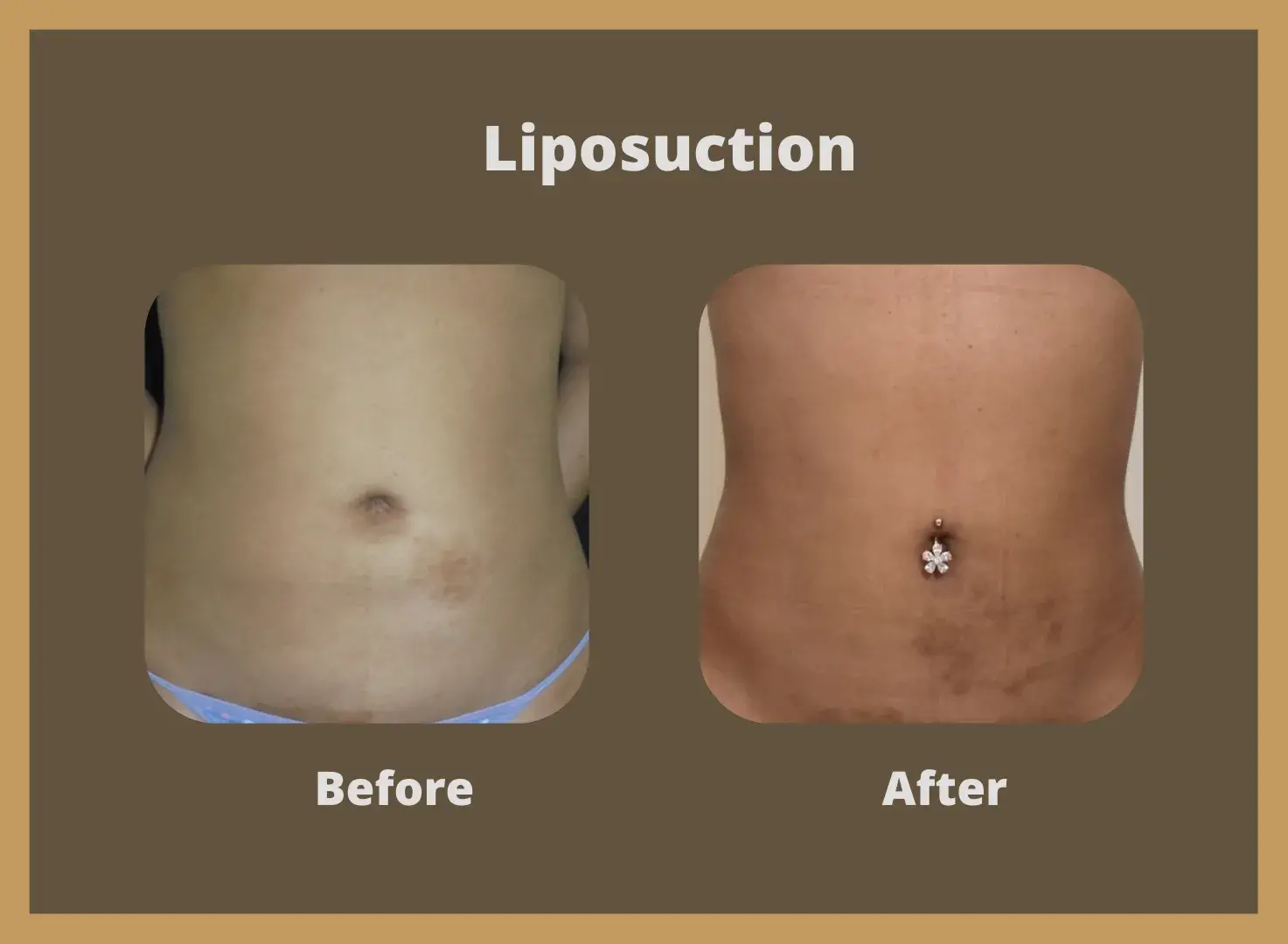 Liposuction