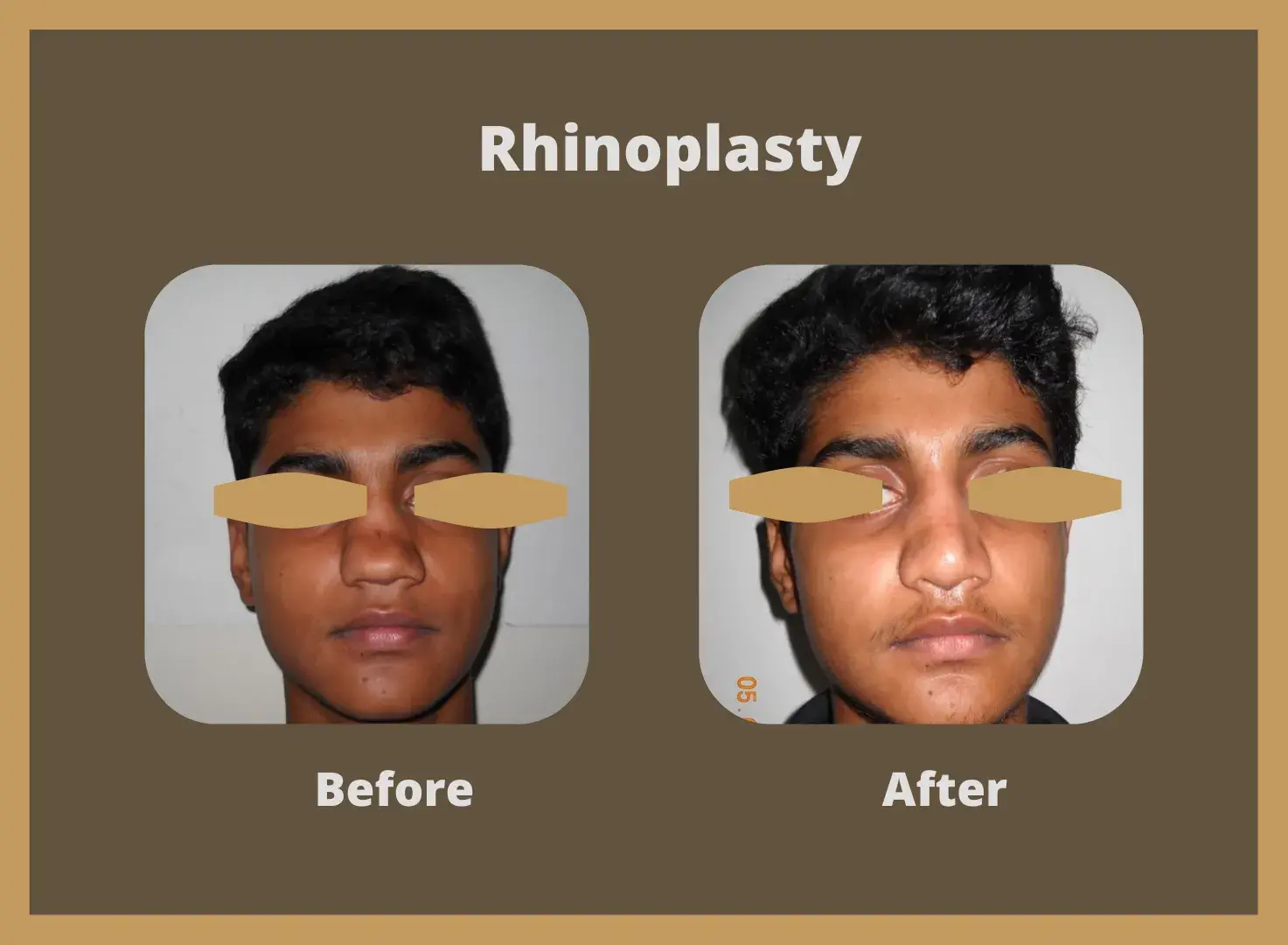 Rhinoplasty-12
