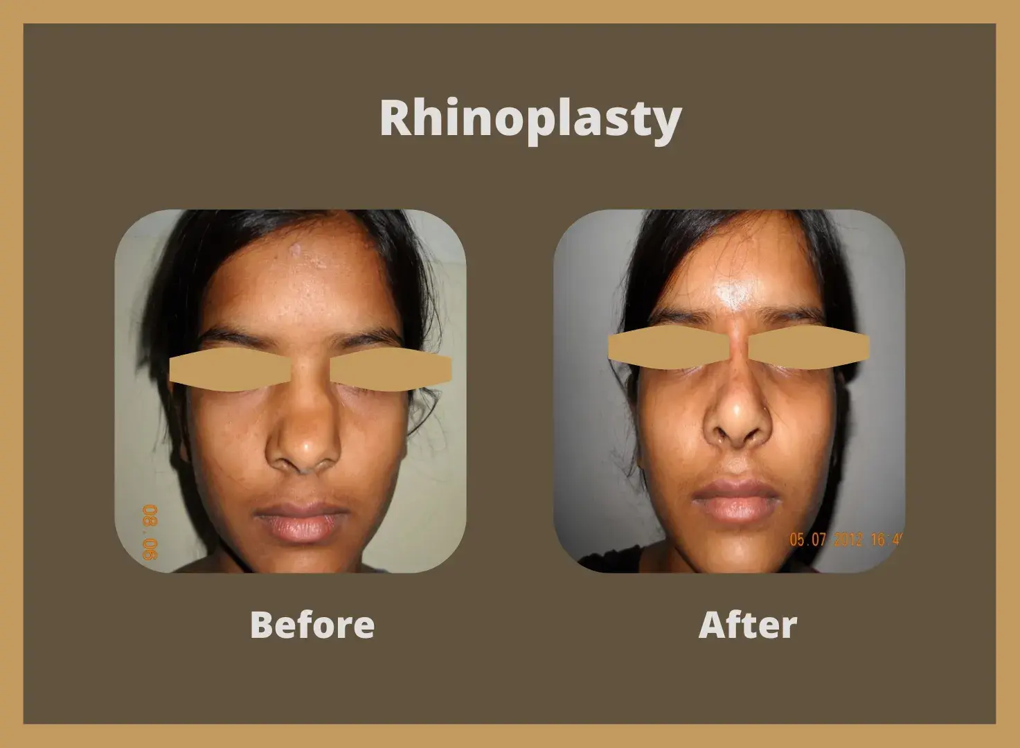 Rhinoplasty-6