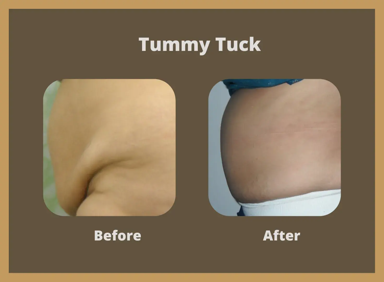 Tummy-Tuck-2