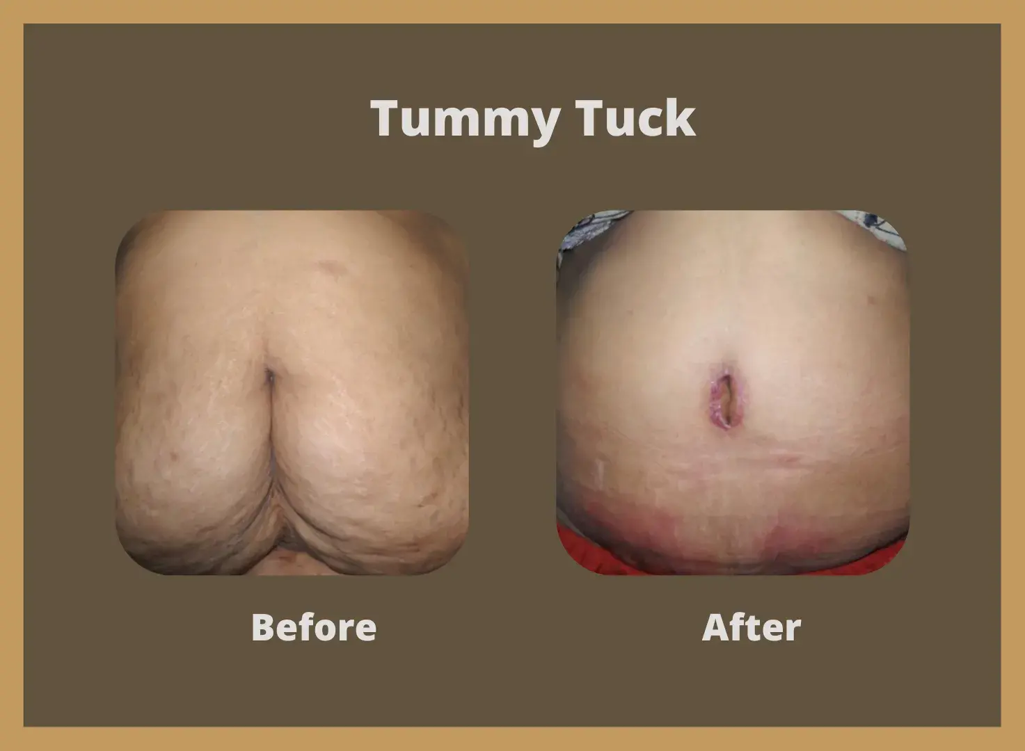 Tummy-Tuck