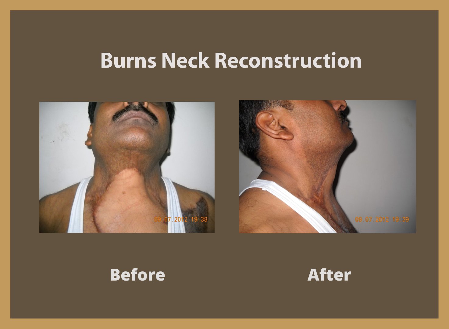 burn-neck-1