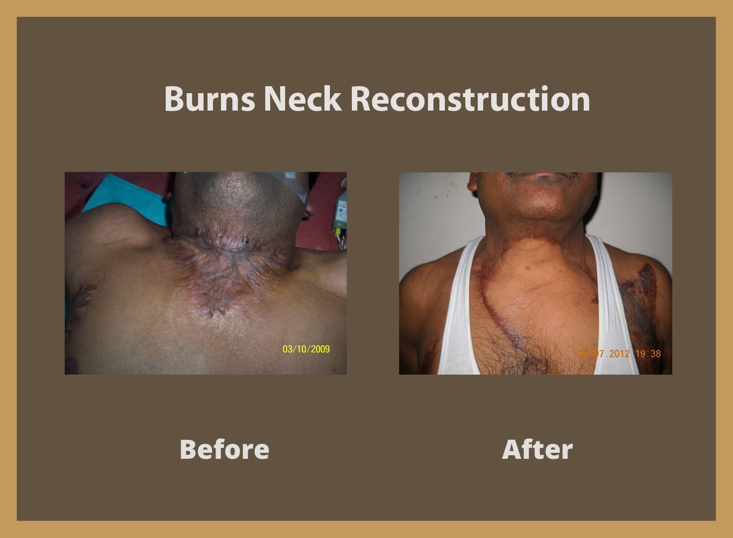burn-neck