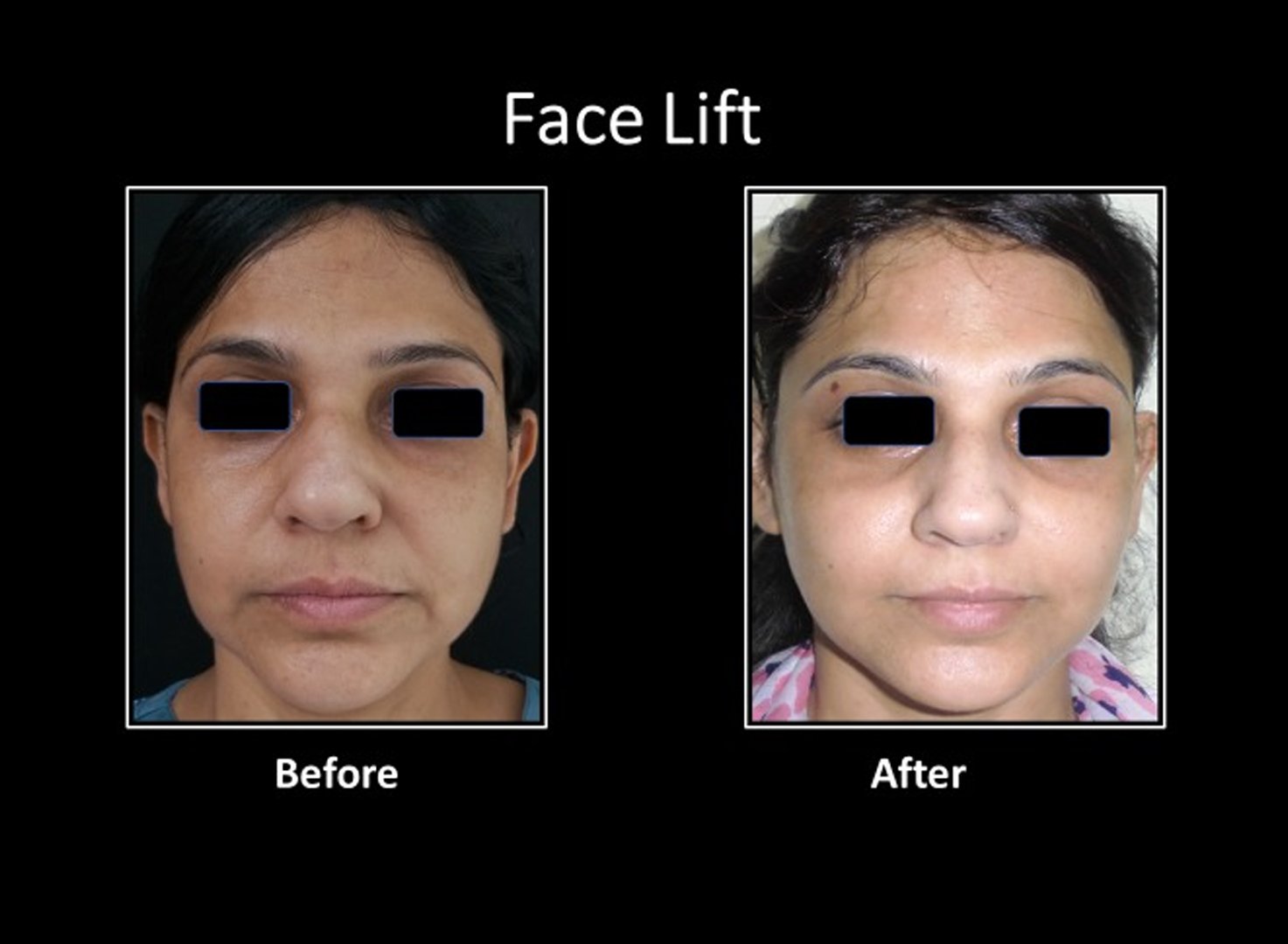 face-lift