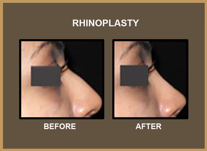 rhinoplasty-8