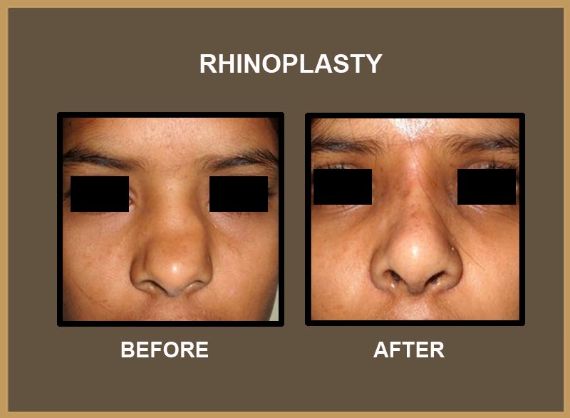 rhinoplasty-9